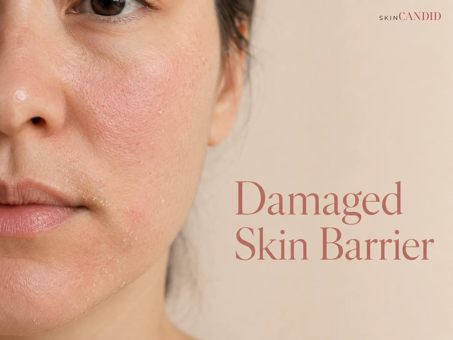Close-up of the cheek and mouth area with mild redness, rough dryness and subtle flaking.