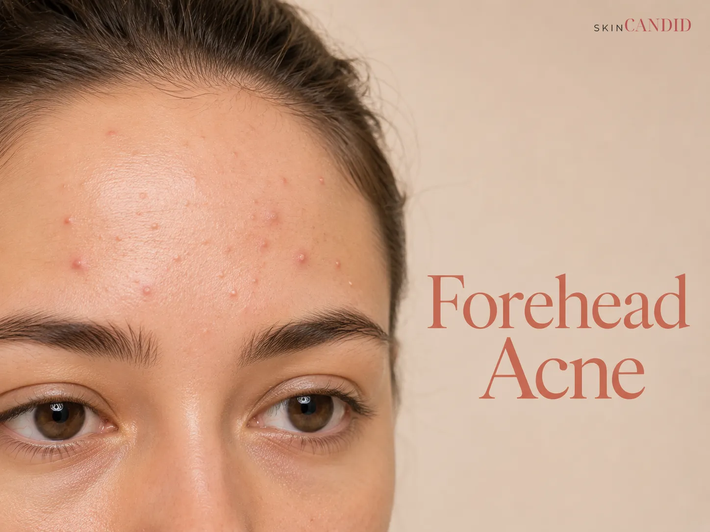 Close-up of forehead and temples with small closed comedones, papules, a few pustules and mild T-zone shine.