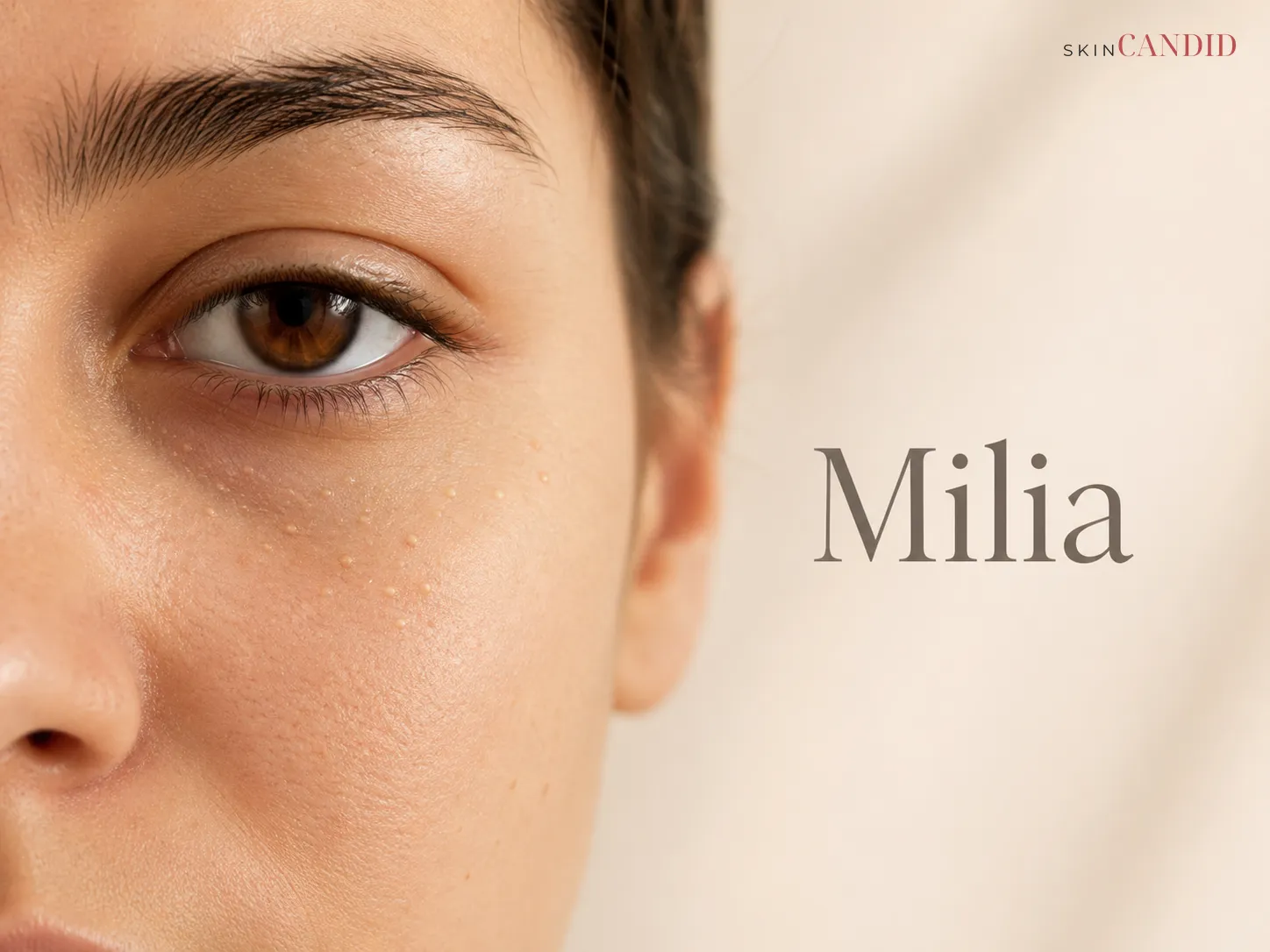 Close-up of the under-eye and upper cheek with several tiny pearly-white milia bumps.