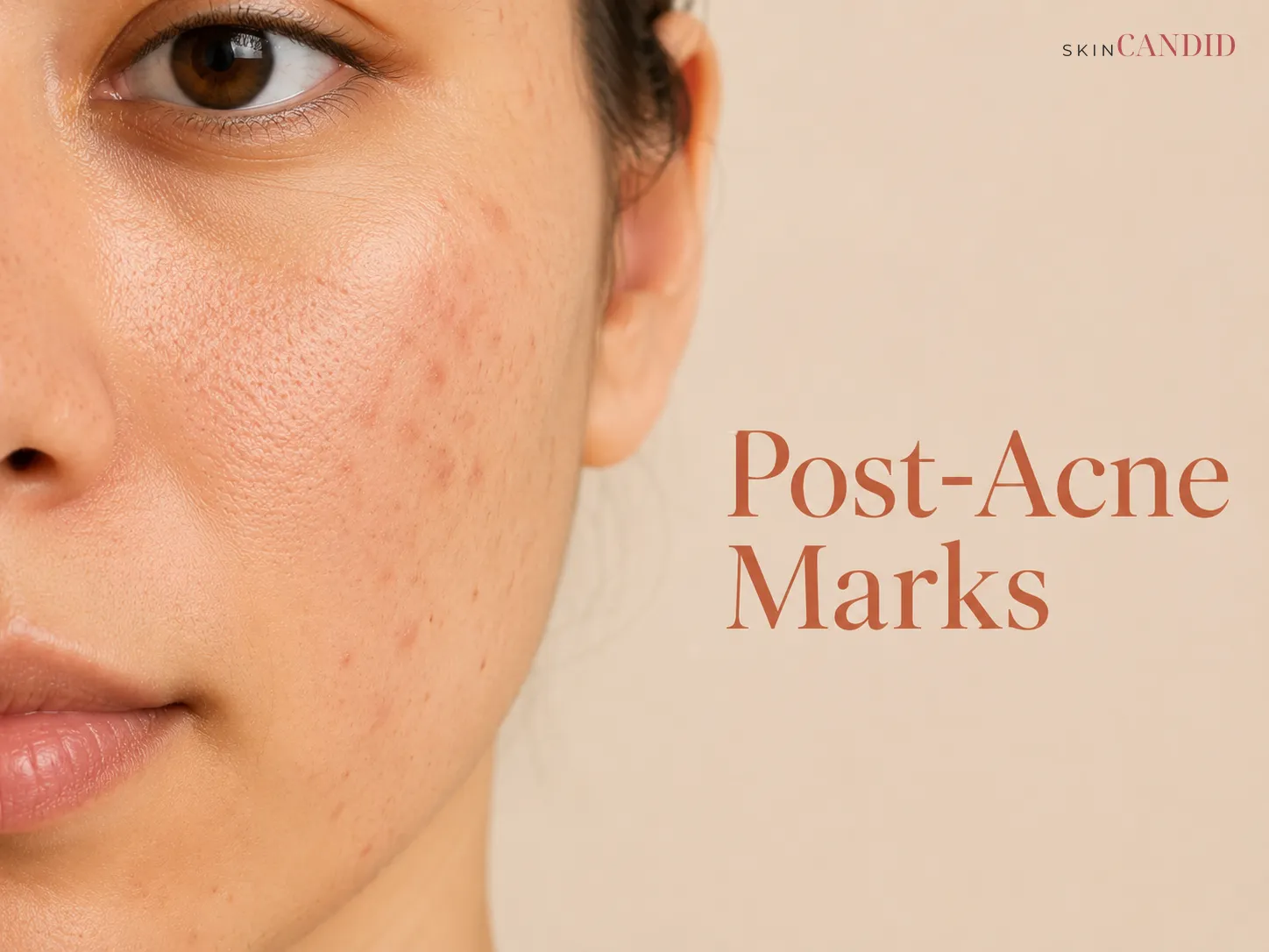 Close-up of a cheek with mostly flat red-brown and brown post-acne marks and minimal active acne.