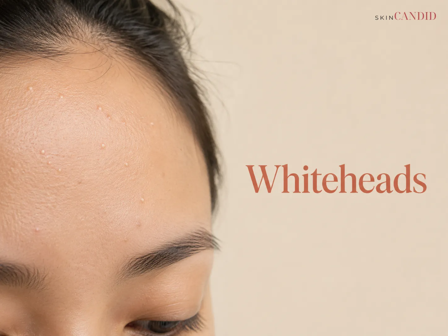 Close-up of naturally textured skin with a small number of subtle closed comedones.